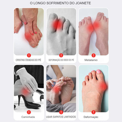 Corretor de Joanete para Dedão do Pé - Separador Ortopédico Ajustável para Alívio da Dor e Correção do Hallux Valgus