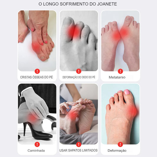 Corretor de Joanete para Dedão do Pé - Separador Ortopédico Ajustável para Alívio da Dor e Correção do Hallux Valgus